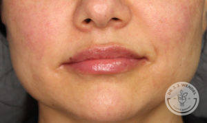 close up of white woman's lips after lip filler