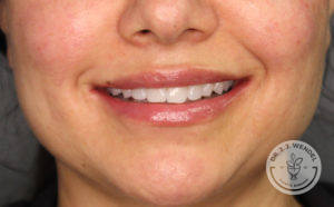 close up of white woman's lips smiling after lip filler