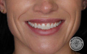 close up of woman's lips smiling after vollure treatment