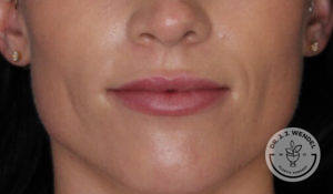 close up of woman's lips after vollure treatment