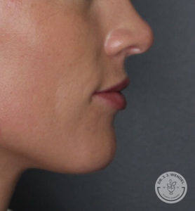 side profile of white woman's lips after vollure treatment