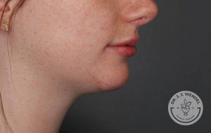 close up of white woman's side profile of lower face after voluma treatment