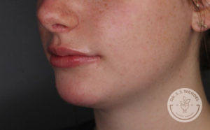 close up of white woman's lower face after voluma treatment