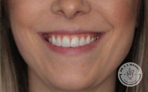 close up of white woman's lips smiling before juvederm lip filler