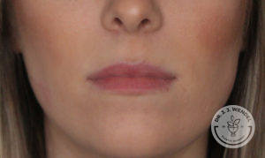close up of white woman's lips before juvederm lip filler
