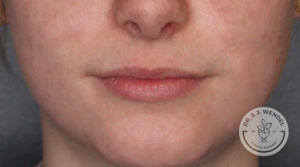 close up of woman's lips before juvederm treatment