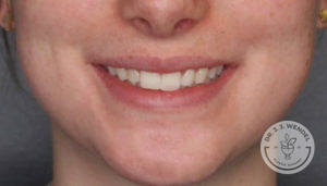 close up of woman's lips smiling before juvederm treatment