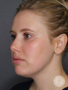 side profile of white blonde before kybella treatment