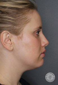 Side profile of blonde woman's face before Kybella