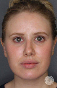 Close-up of blonde woman's face before Kybella treatment