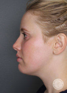 side profile of white blonde before kybella treatment