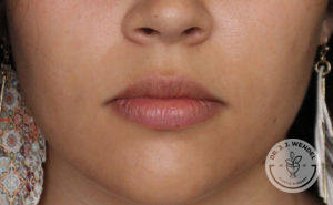 close up of white woman's lips before lip filler
