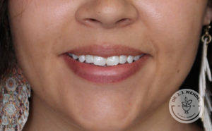 close up of white woman's lips smiling before lip filler