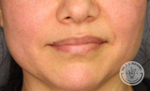 close up of white woman's lips before lip filler