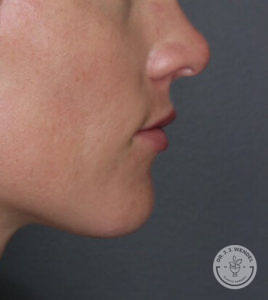 side profile of white woman's lips before vollure treatment