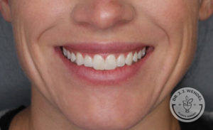 close up of woman's lips smiling before vollure treatment