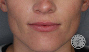 close up of woman's lips before vollure treatment