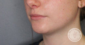 close up of white woman's lower face before voluma treatment