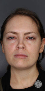 Brunette woman with green eyes after botox vollure
