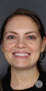 Brunette woman with green eyes smiling after botox vollure treatment