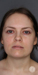 Brunette woman with green eyes before botox vollure