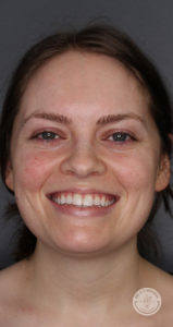 Brunette woman with green eyes smiling before botox vollure