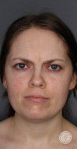 Brunette woman with green eyes before botox vollure