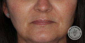 Woman's thin lips before receiving Kysse lip filler