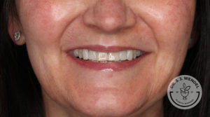 Woman smiling after receiving Restylane Kysse lip filler