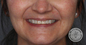 Before image of a woman smiling before receiving Restylane Kysse lip filler