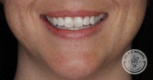 Woman's smile after Botox Lip Flip