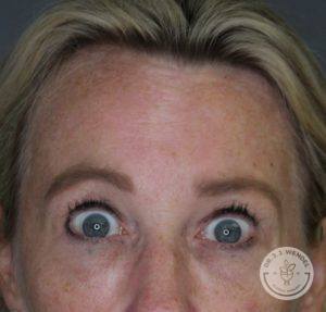 Woman with no wrinkles on her forehead after liquid facelift
