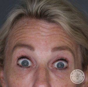 Close-up image of wrinkles on a white woman's forehead