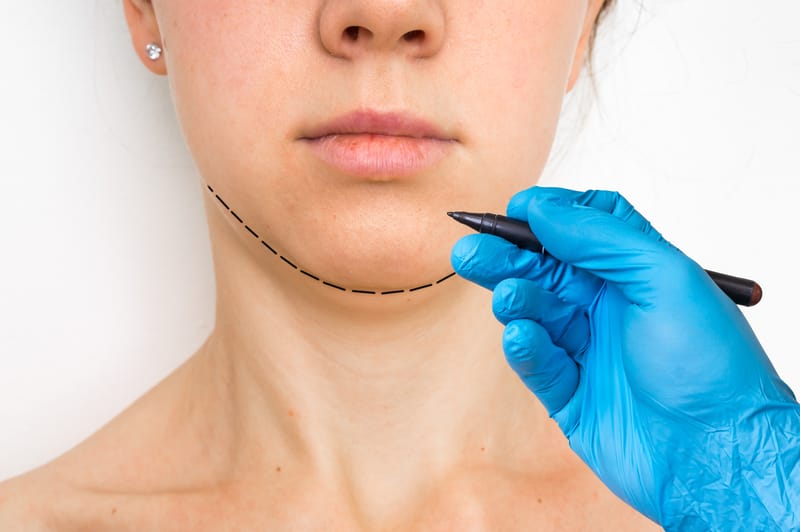Blue glove holding black pen drawing a surgical line on woman's chin