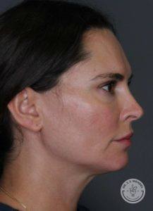 side profile of white brunette after filler