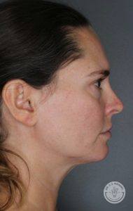 Side profile of a brunette woman before filler