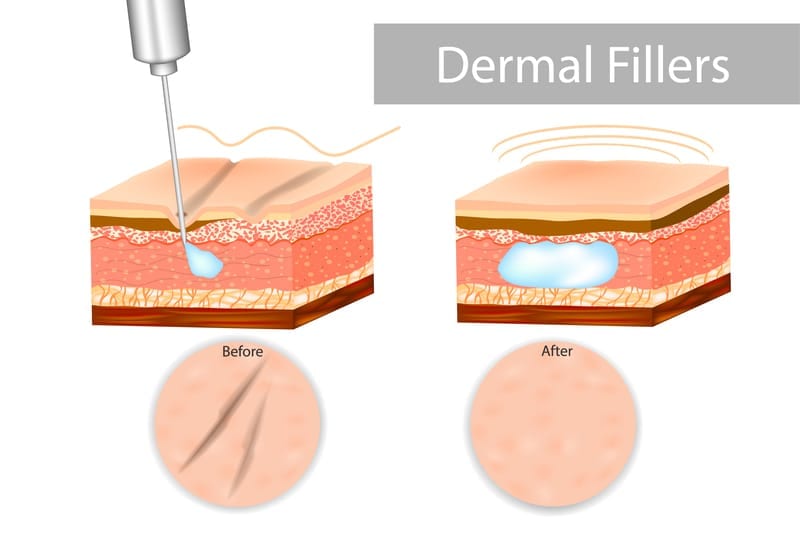 Dermal fillers before and after