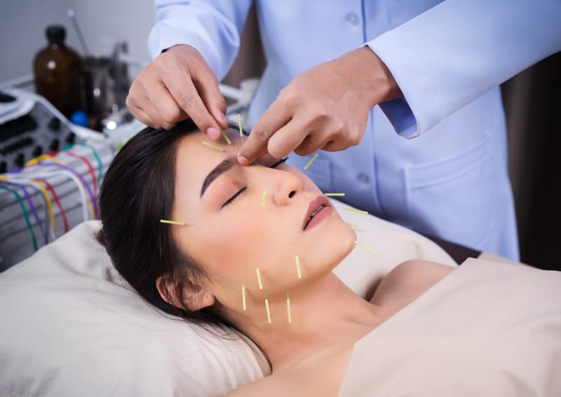Doctor placing acupuncture needles into woman's face