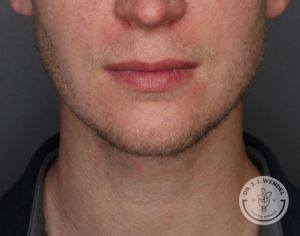 Front view of man after Kybella