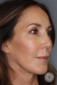 Woman after liquid facelift