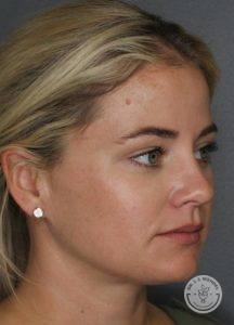 side profile of blonde woman after skin treatment
