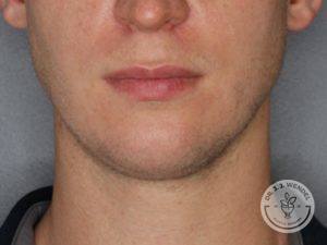Front view of man before Kybella