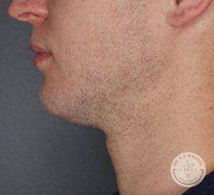 Left of Man before Kybella