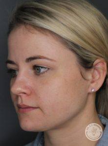 Blonde woman before skin treatment