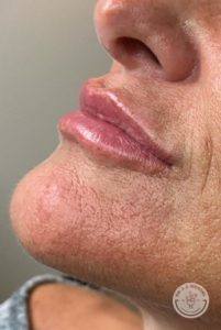 woman's lips after volbella treatment