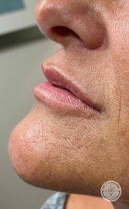 woman's lips before volbella treatment