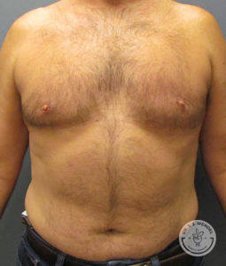 male patient after gynecomastia and liposuction