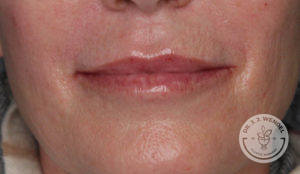 after juvederm