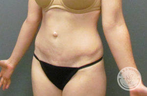 female torso after tummy tuck
