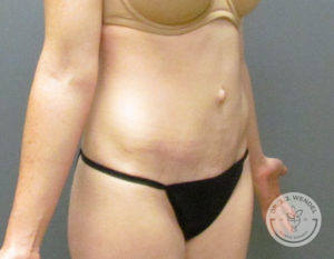 female torso after tummy tuck